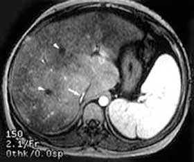 Ultraschall Leberdurchblutungsverhältnisse