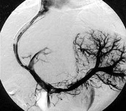 Ultraschall Gefäßkatheter