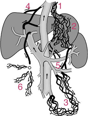 Abbildung 1: Umgehungskreisläufe bei Pfortaderhochdruck infolge Leberzirrhose. Unter anderem Ösophagusvarizen (1), Magenvarizen (2), rektaler Venenplexus (3), Sappey- Venen (4), Retzius- Venen (5) und 