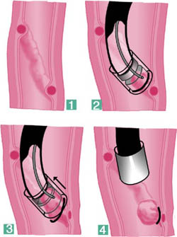 Abb. 2: Endoskopische Bandligatur von Ösophagusvarizen