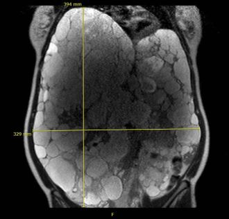 MRT einer Zystenleber
