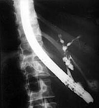 Abb. 1: Röntgenbild einer Gallengangsveränderung bei PSC, Gallengänge mit Engstellen und Erweiterungen. Erste Darstellung vor einer Ballondilatation der Gallengänge.